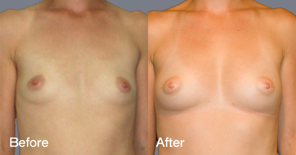 Fat transfer breast augmentation describes the procedure where fat is moved from different areas of the body to the breasts to increase the volume and enhance the shape. Before And After Fat Transfer Breast Augmentation Surgery, Front View - Patient 8
