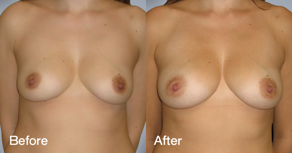 Fat transfer breast augmentation describes the procedure where fat is moved from different areas of the body to the breasts to increase the volume and enhance the shape. Before And After Fat Transfer Breast Augmentation Surgery, Front View - Patient 9