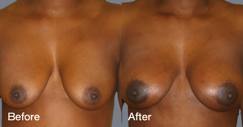 Fat transfer breast augmentation describes the procedure where fat is moved from different areas of the body to the breasts to increase the volume and enhance the shape. Before And After Fat Transfer Breast Augmentation Surgery, Front View - Patient 10