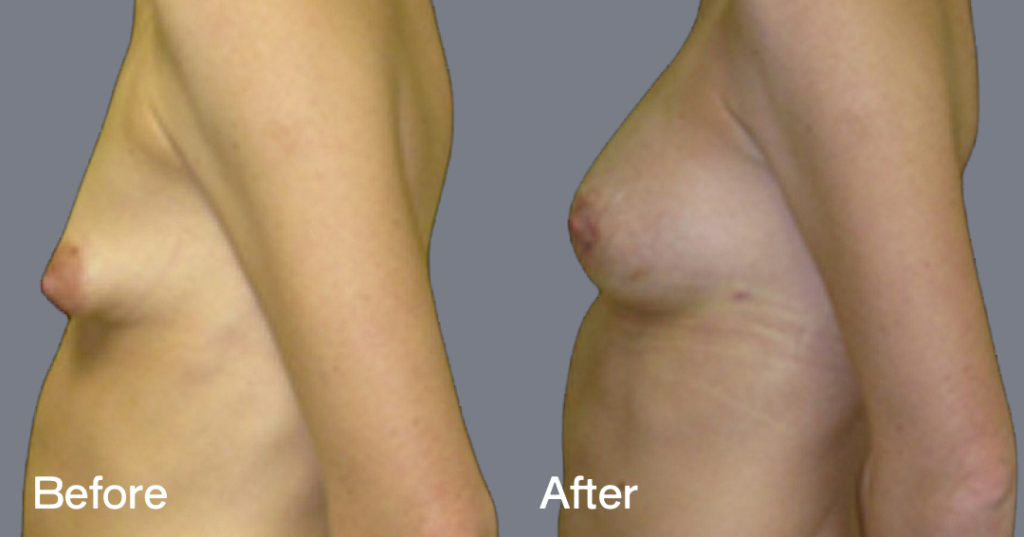 Fat transfer breast augmentation describes the procedure where fat is moved from different areas of the body to the breasts to increase the volume and enhance the shape. Before And After Fat Transfer Breast Augmentation Surgery, Left View - Patient 11