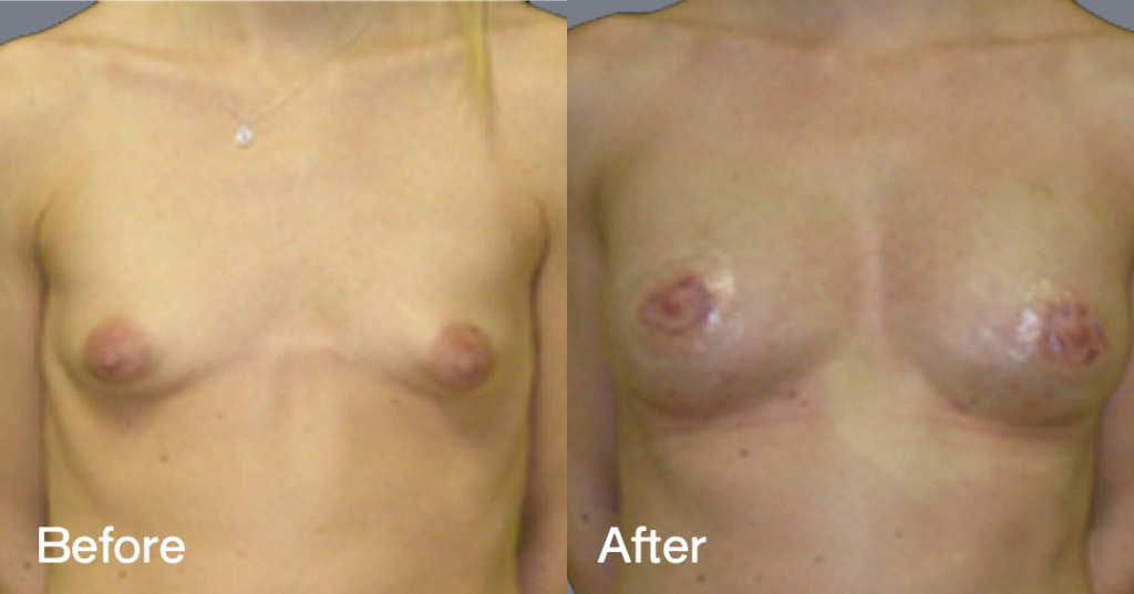 Fat transfer breast augmentation describes the procedure where fat is moved from different areas of the body to the breasts to increase the volume and enhance the shape. Before And After Fat Transfer Breast Augmentation Surgery, Front View - Patient 11