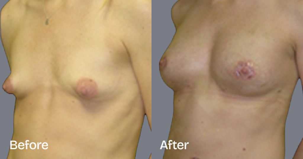Fat transfer breast augmentation describes the procedure where fat is moved from different areas of the body to the breasts to increase the volume and enhance the shape. Before And After Fat Transfer Breast Augmentation Surgery, Front Left View - Patient 11