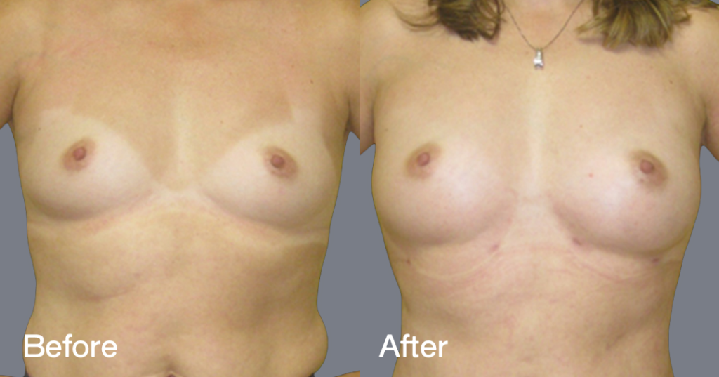 Fat transfer breast augmentation describes the procedure where fat is moved from different areas of the body to the breasts to increase the volume and enhance the shape. Before And After Fat Transfer Breast Augmentation Surgery, Front View - Patient 12