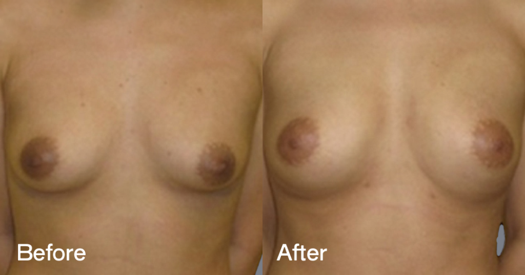 Fat transfer breast augmentation describes the procedure where fat is moved from different areas of the body to the breasts to increase the volume and enhance the shape. Before And After Fat Transfer Breast Augmentation Surgery, Front View - Patient 14