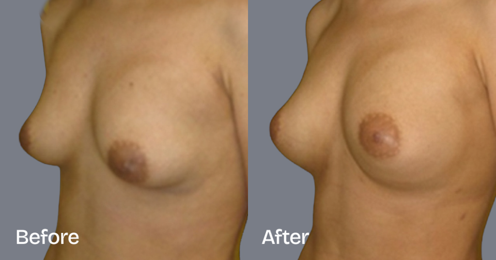 Fat transfer breast augmentation describes the procedure where fat is moved from different areas of the body to the breasts to increase the volume and enhance the shape. Before And After Fat Transfer Breast Augmentation Surgery, Front Left View - Patient 14