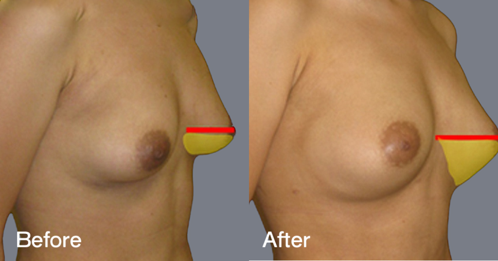 Fat transfer breast augmentation describes the procedure where fat is moved from different areas of the body to the breasts to increase the volume and enhance the shape. Before And After Fat Transfer Breast Augmentation Surgery, Front Right View - Patient 14