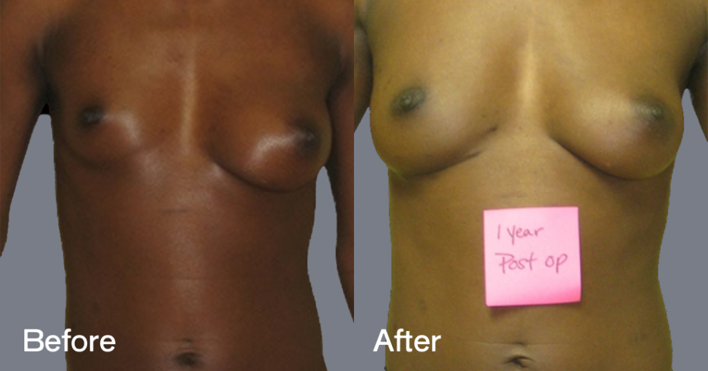 Fat transfer breast augmentation describes the procedure where fat is moved from different areas of the body to the breasts to increase the volume and enhance the shape. Before And After Fat Transfer Breast Augmentation Surgery, Front View - Patient 16