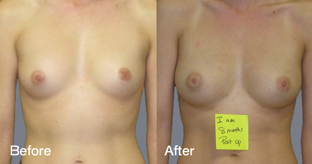 Fat transfer breast augmentation describes the procedure where fat is moved from different areas of the body to the breasts to increase the volume and enhance the shape. Before And After Fat Transfer Breast Augmentation Surgery, Front View - Patient 17