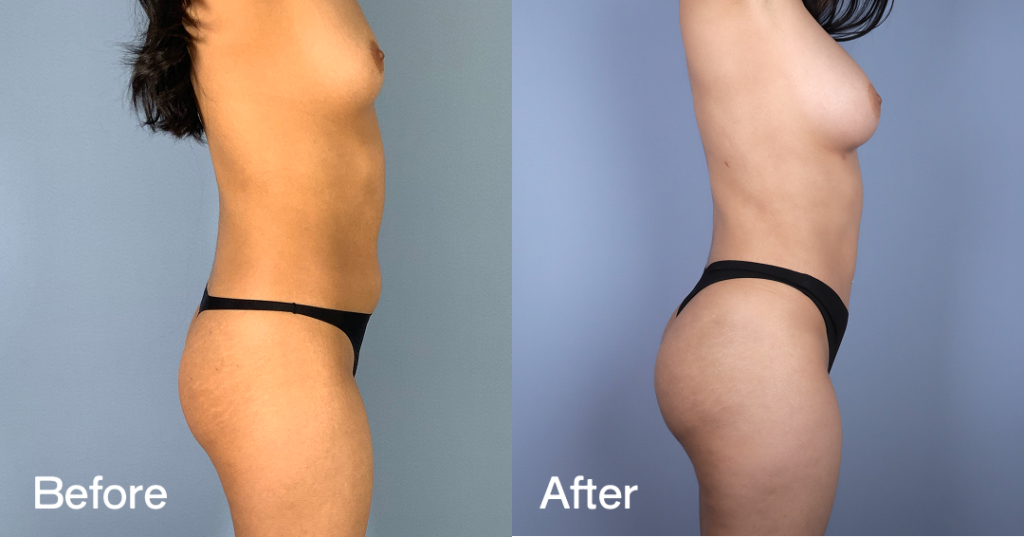 If youโre looking for a Brazilian butt lift (BBL) in London, you need a skilled surgeon to keep you safe while sculpting the curves youโve always wanted. Brazilian Butt Lift (Bbl)
