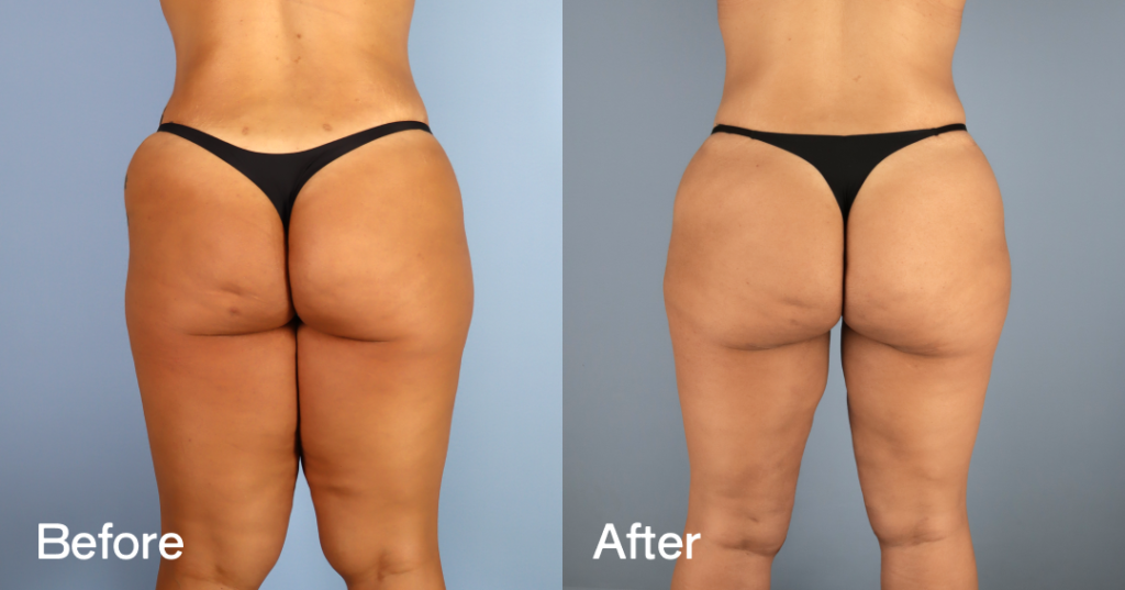 Before And After Thigh Lift, Back View - Patient 12380240