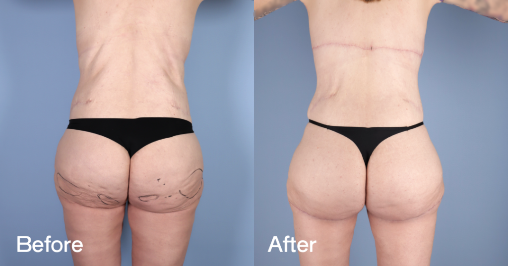 Before And After Back Lift, Back View โ Patient 12379532