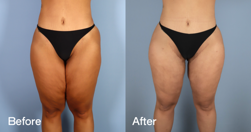 Before And After Thigh Lift, Front View. - Patient 12380240