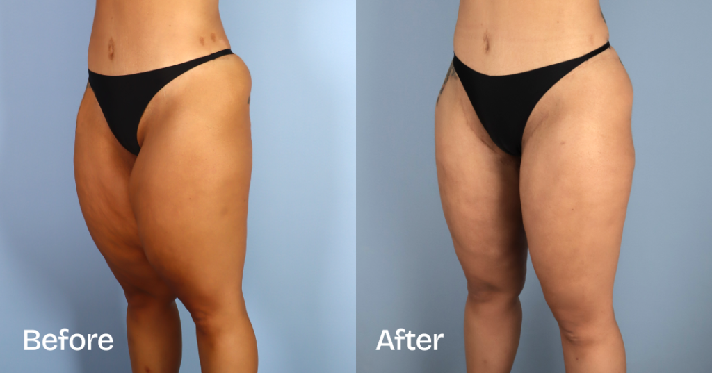 Before And After Thigh Lift, Side View - Patient 12380240