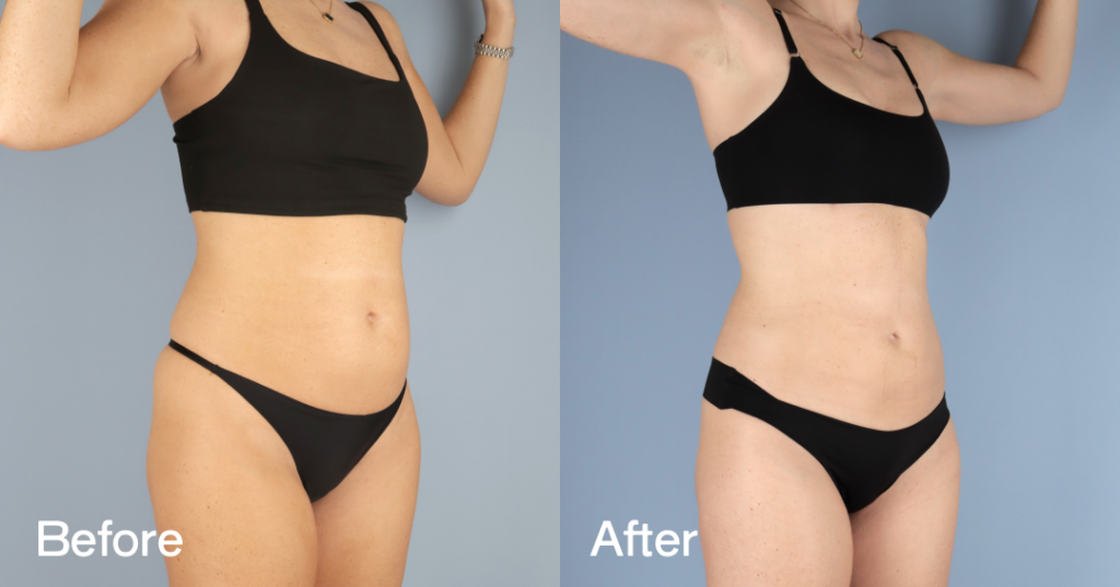 Youโre so close to the body you want, but those last few stubborn fat deposits wonโt budge. With liposuction in London, Dr. Omar Tillo will remove excess fat to sculpt and define your figure, giving you the slimmer silhouette youโve been working toward. Before And After Liposuction, Front Right View - Patient 12308532