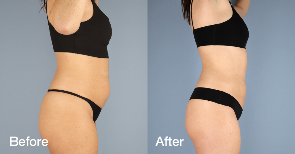 Youโre so close to the body you want, but those last few stubborn fat deposits wonโt budge. With liposuction in London, Dr. Omar Tillo will remove excess fat to sculpt and define your figure, giving you the slimmer silhouette youโve been working toward. Before And After Liposuction, Right View. - Patient 12308532
