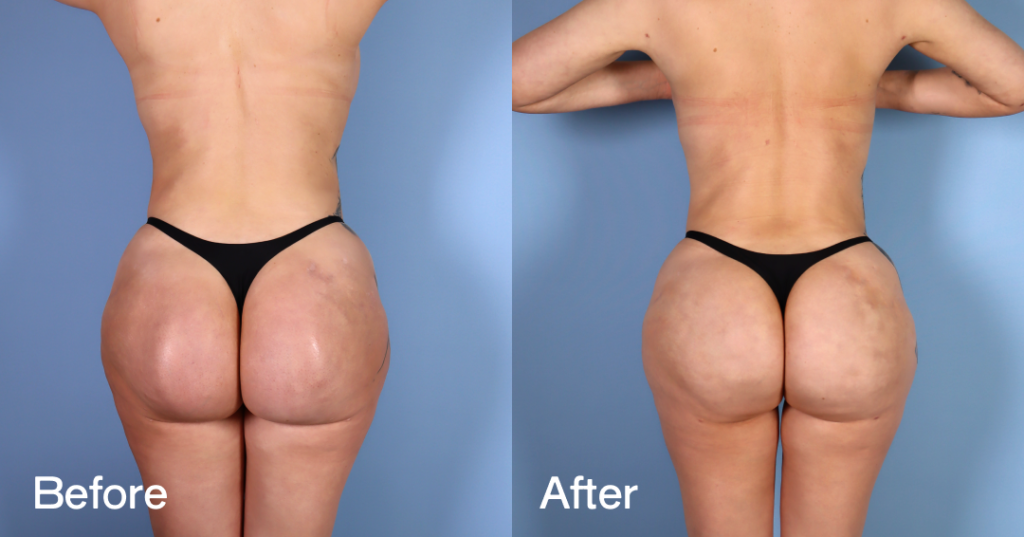 Before And After - Buttock Implant Removal - Back - 12380232
