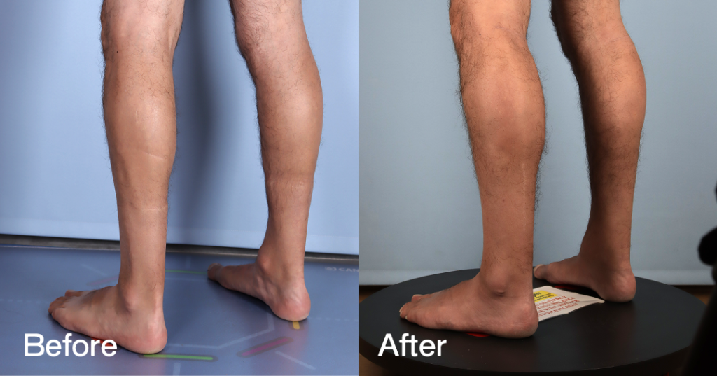 The CREO Clinic offers standard and custom-made calf implants, with treatment planning led by Dr Tillo’s lower-limb and body-contouring expertise. Where appropriate, custom implants may be considered for patients with specific anatomical requirements, asymmetry, or complex contouring goals, following detailed consultation and assessment.  Before And After - Calf Augmentation - Back Left - 12380409
