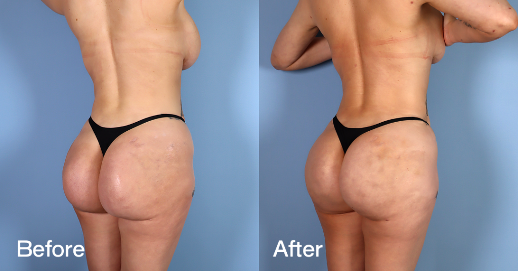 Before And After - Buttock Implant Removal - Back Right - 12380232