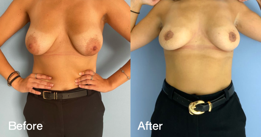 As with other physical traits, there is a significant genetic influence on areola size. When the breasts develop during puberty, the areolas can become enlarged in a way that may be a concern for some patients, and may be assessed for areola reduction surgery following consultation. Before And After, Areola Reduction, Front View, Patient 326