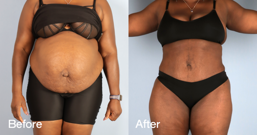 Learn whether a breast reduction or breast lift is right for your desired cosmetic goals from CREO Clinic in London. Before And After — Lipo-Abdominoplasty With Fat Transfer To The Breasts — 12380290