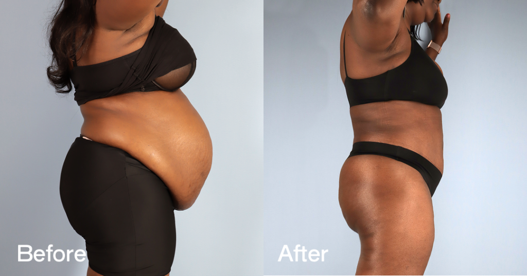 Learn whether a breast reduction or breast lift is right for your desired cosmetic goals from CREO Clinic in London. Before And After — Lipo-Abdominoplasty With Fat Transfer To The Breasts — 12380290