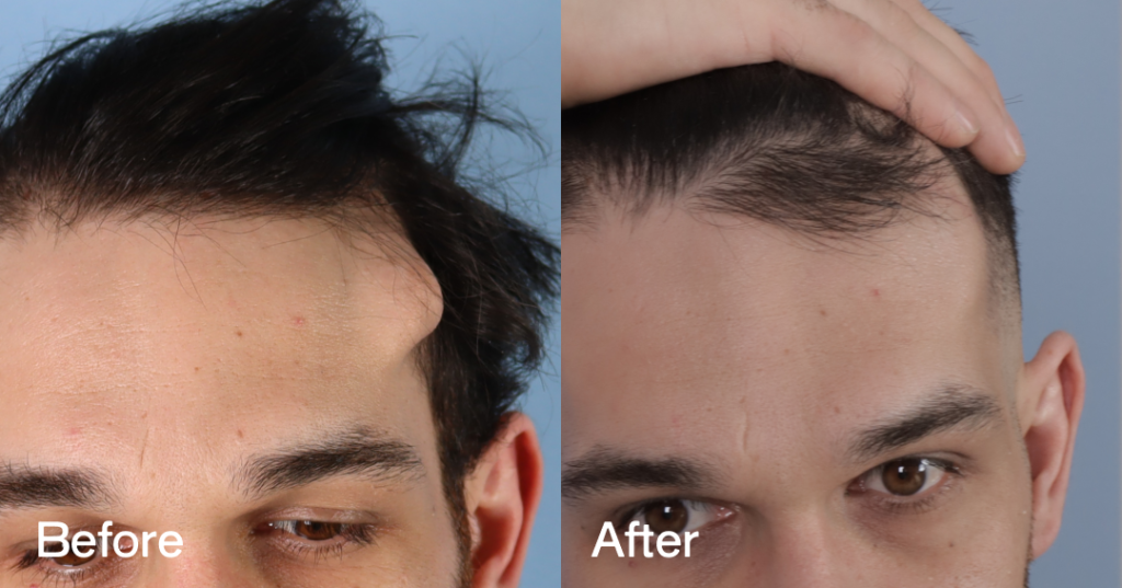 Osteoma removal excises benign bony growths, often on the forehead, at CREO Clinic in London. Before And After Osteoma Removal, Front View - Patient 333.