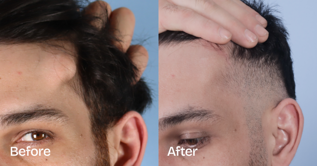 Osteoma removal excises benign bony growths, often on the forehead, at CREO Clinic in London. Before And After Osteoma Removal, Left Front View — Patient 333