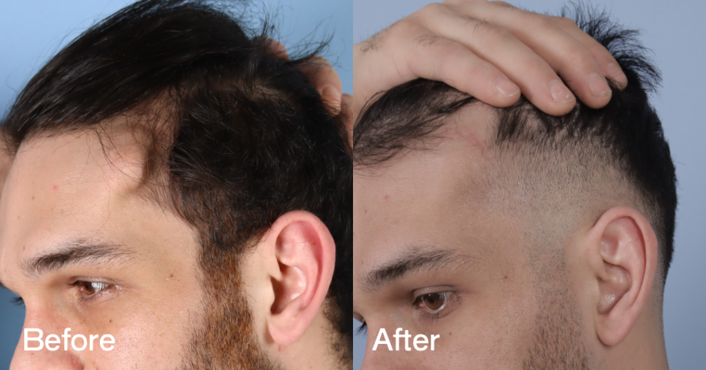 Osteoma removal excises benign bony growths, often on the forehead, at CREO Clinic in London. Before And After Osteoma Removal, Left View — Patient 333