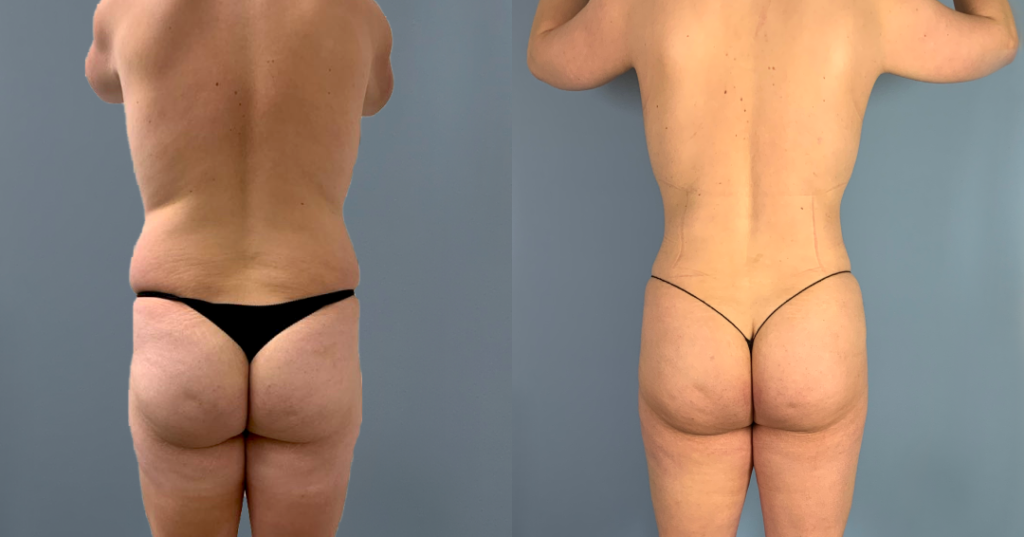 Before And After Male Bbl, Back View, Patient 334