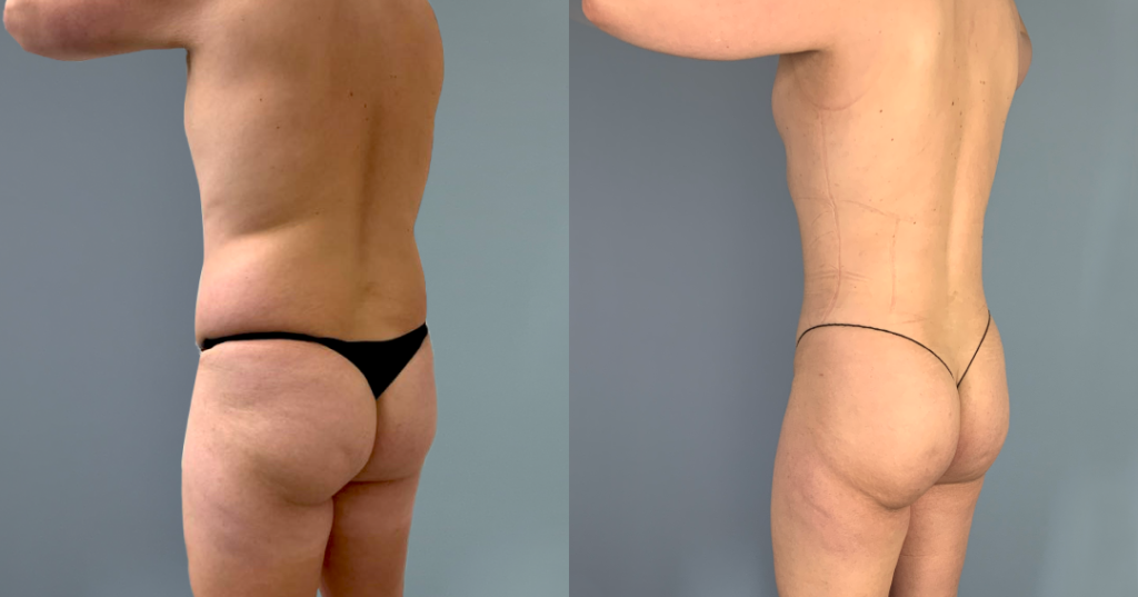 Before And After Male Bbl, Back Left View, Patient 334