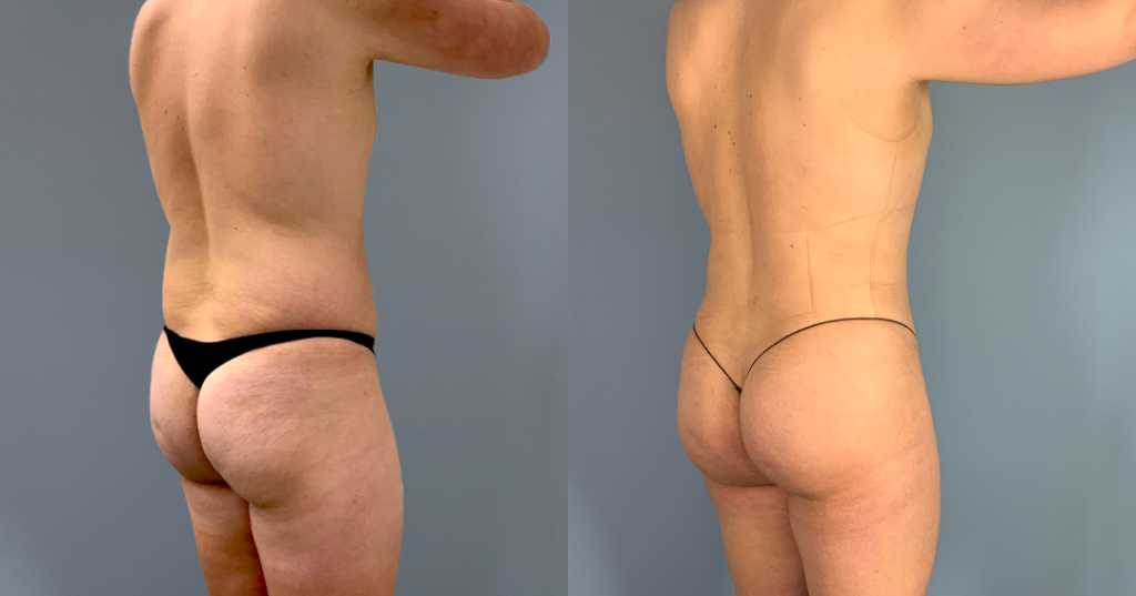 Before And After Male Bbl, Back Right View, Patient 334