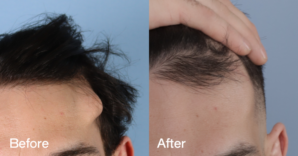Osteoma removal excises benign bony growths, often on the forehead, at CREO Clinic in London. Before And After Osteoma Removal, Front View - Patient 333