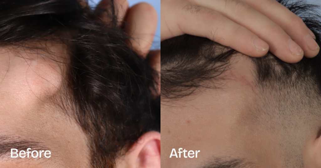 Osteoma removal excises benign bony growths, often on the forehead, at CREO Clinic in London. Before And After Osteoma Removal, Front Left View - Patient 333