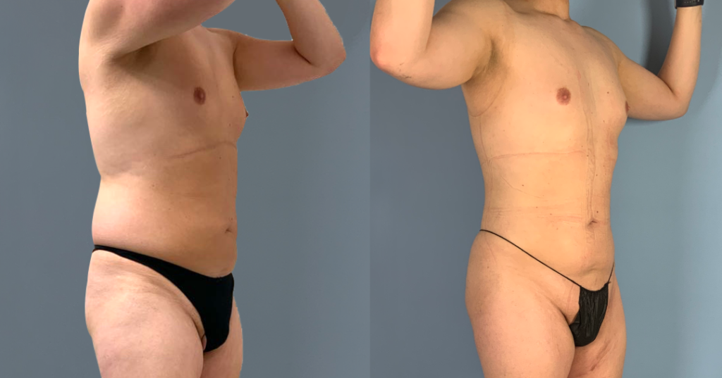 Before And After Male Bbl, Front Right View, Patient 334