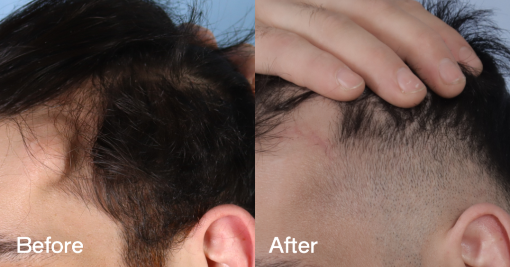 Osteoma removal excises benign bony growths, often on the forehead, at CREO Clinic in London. Before And After Osteoma Removal. Left View - Patient 333